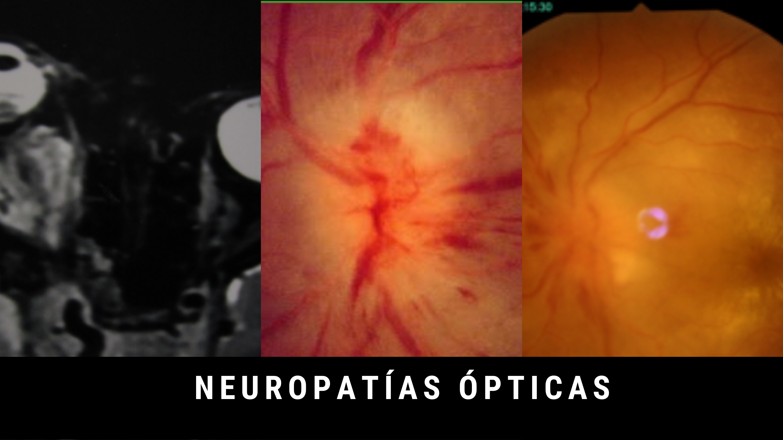 Abordaje Diagnóstico en Neuropatías Ópticas